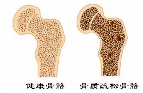 骨質(zhì)疏松可防可治